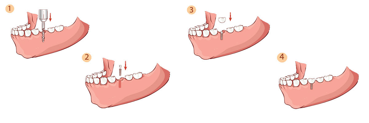 Lindsay Dental Implant Restoration
